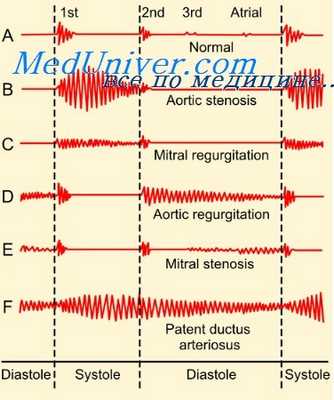 сердце при дмпп