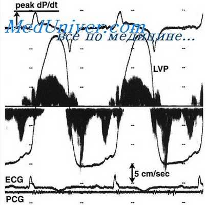 легочная гипертензия