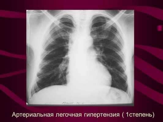 Легочная гипертензия