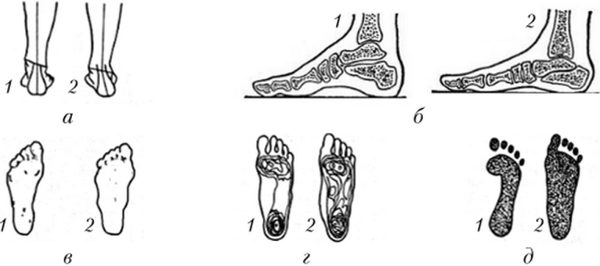 Форма стопы в норме (1) и при плоскостопии (2)