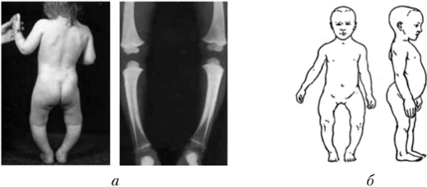 Изменение скелета при рахите