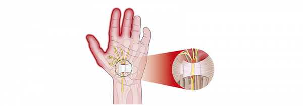 Повреждения нервов верхних и нижних конечностей (периферических нервов)