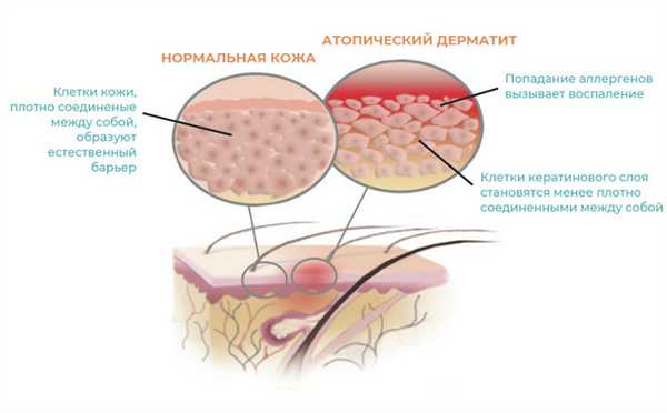 Атопический дерматит
