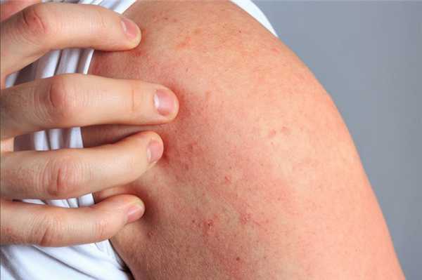 Атопический дерматит — симптомы, причины, лечение