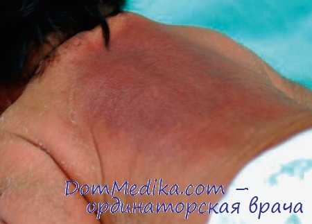 склерема новорожденных