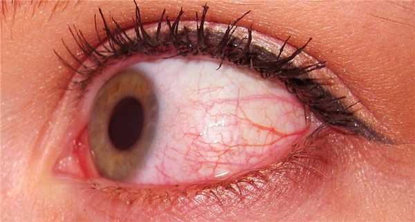 склера истончается и в любой момент может порваться