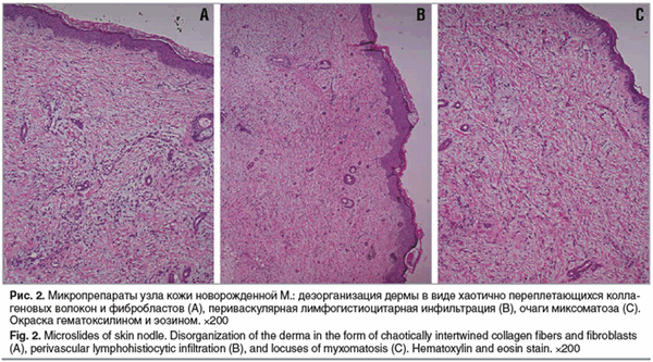 Рис. 2. Микропрепараты узла кожи новорожденной М.: дезорганизация дермы в виде хаотично переплетающихся колла- геновых волокон и фибробластов (A), периваскулярная лимфогистиоцитарная инфильтрация (B), очаги миксоматоза (C). Окраска гематоксилином и эозино