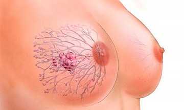 Фото Фиброз молочной железы