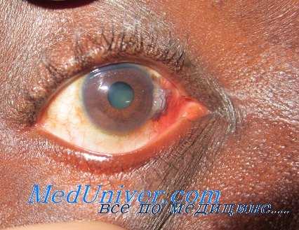 саркоидоз глаза