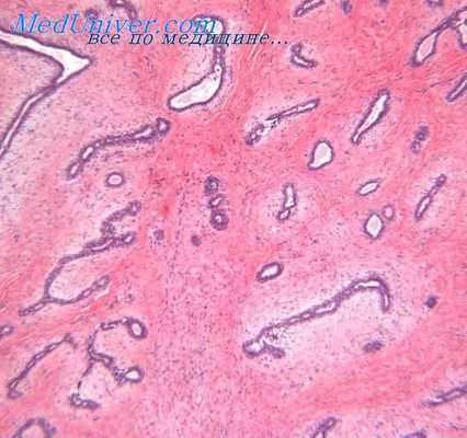 склерозирующий рак протоков потовых желез