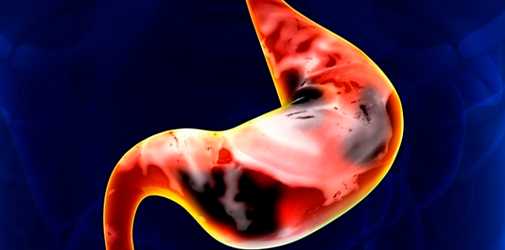 Виды гастрита - Алкоклиник