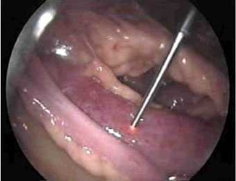 Рис. 4. Острая спаечная кишечная непроходимость. Измерение микроциркуляции ишемизированной тонкой кишки