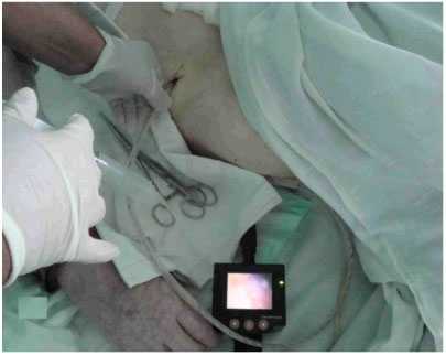 Рис.2. Послеоперационное видеолапароскопическое мониторирование брюшной полости. Исследование микроциркуляции серозной оболочки кишечника проводилось лазерным анализатором капиллярного кровотока ЛАКК-02