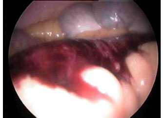 Рис. Сегментарный некроз подвздошной кишки при остром мезентериальном тромбозе