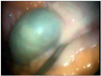 Рис. Острое нарушение мезентериального кровообращения, некроз купола слепой кишки