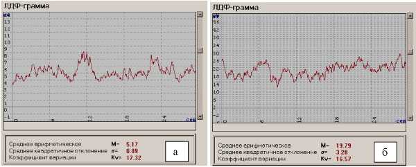 Рис. 5. Показатели микроциркуляции ишемизированной тонкой кишки (а) и после восстановления кровообращения после устранения (б) острой спаечной тонко­кишечной непроходимости 