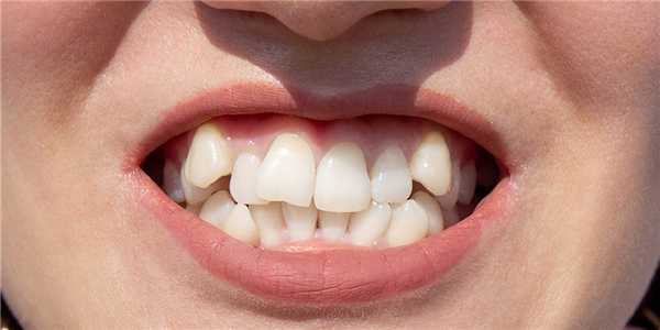 Скученность зубов