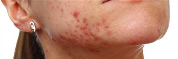 Фото как выглядит постакне