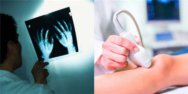 Диагностика псориатического артрита