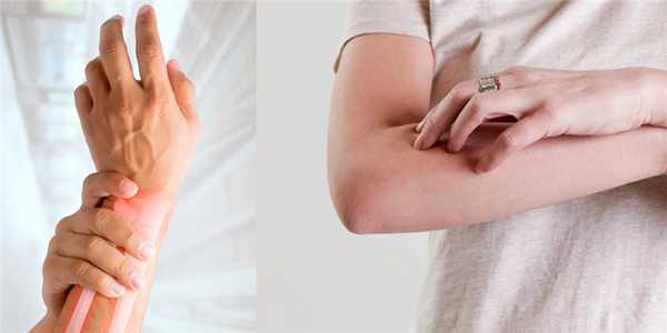 Симптомы псориатического артрита