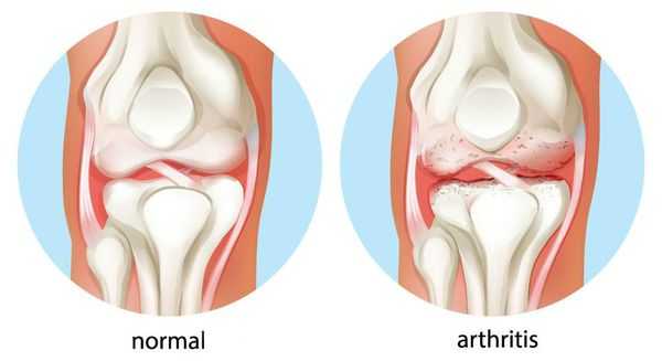 Длительное воспаление суставов