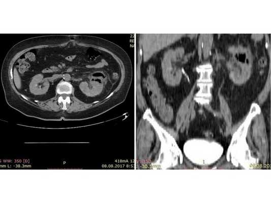 Результат мультиспиральной КТ: видны изменения левой почки, характерные для эмфизематозного пиелонефрита, функция левой почки отсутствует