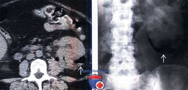 КТ, УЗИ при эмфизематозном пиелонефрите