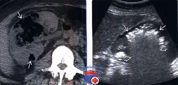 КТ, УЗИ при эмфизематозном пиелонефрите