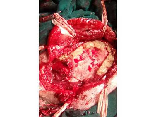 Дефекты твёрдой мозговой оболочки укрыты кусочками гемостатической губки