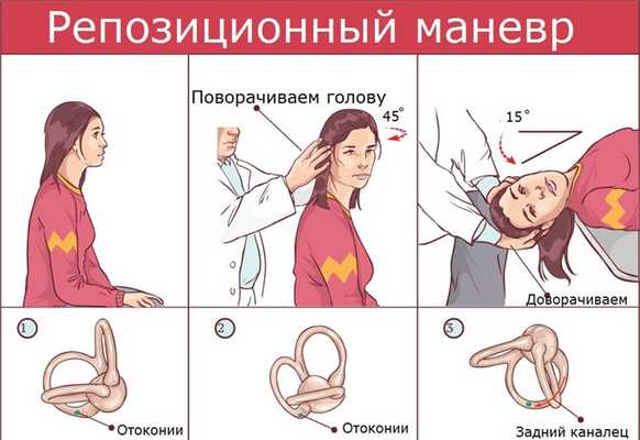 Репозиционный маневр