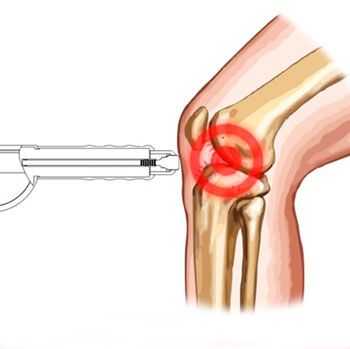 лечение коленного сустава ударно волновой терапией