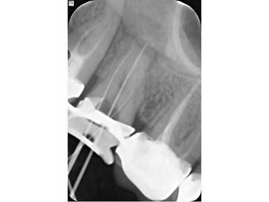 Снимок с инструментом после дезобтурации корней