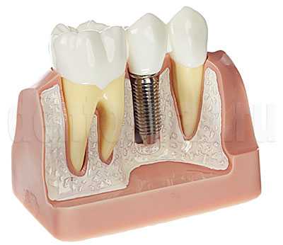 Имплант с коронкой