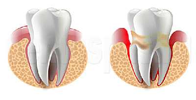 Зубы - здоровый и с периодонтитом