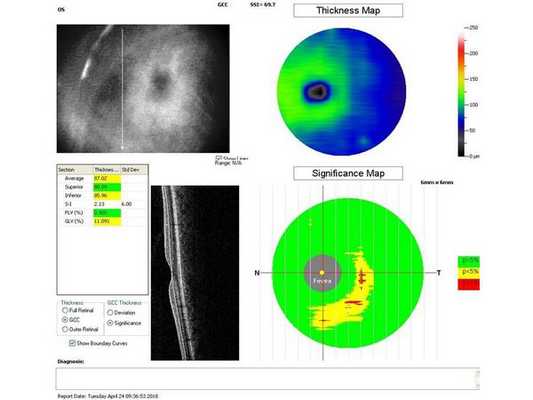 Данные ОКТ через месяц после лазерного лечения