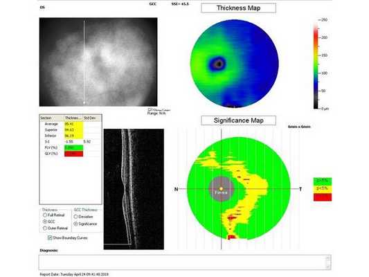 Данные ОКТ на момент первичного осмотра