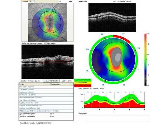 Данные ОКТ через месяц после лазерного лечения