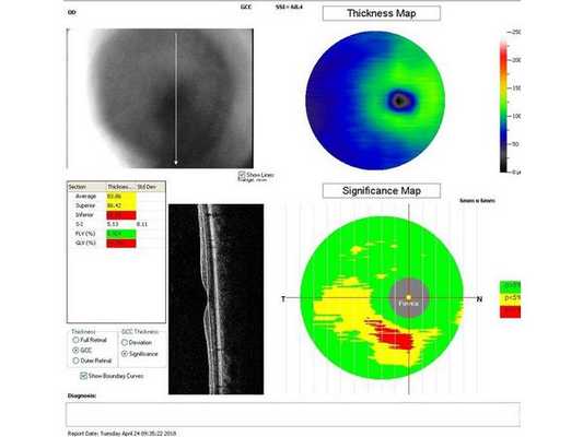 Данные ОКТ через месяц после лазерного лечения