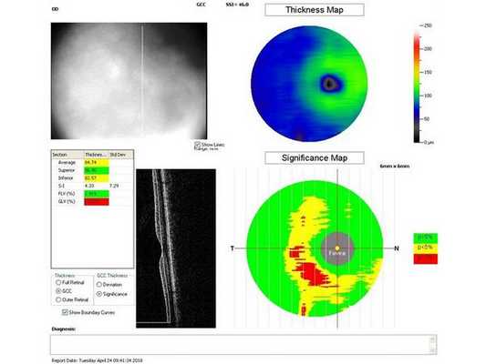 Данные ОКТ на момент первичного осмотра