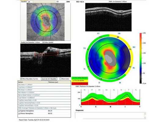 Данные ОКТ на момент первичного осмотра