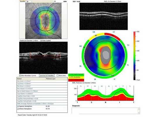 Данные ОКТ на момент первичного осмотра