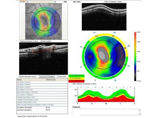 Данные ОКТ через месяц после лазерного лечения