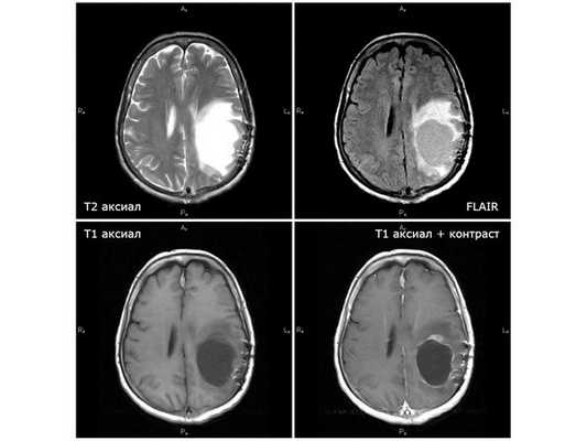 МРТ от 30.10.18 (через 2 недели после первого этапа химиолучевой терапии): феномен псевдопрогрессии