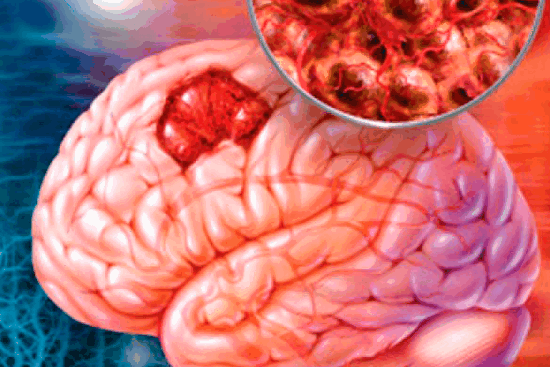 Глиобластома: каковы шансы на жизнь?