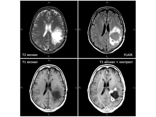 МРТ от 08.02.19: появление дополнительных опухолевых узлов, рост глиобластомы
