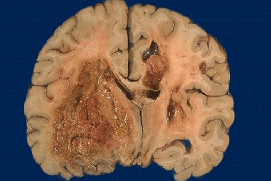 Глиобластома: каковы шансы на жизнь?