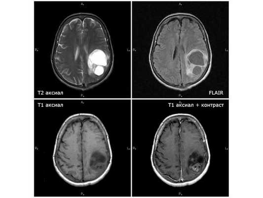 Первая диагностическая МРТ от 11.08.18: кистозно-солидное объёмное образование с отёком вокруг опухоли