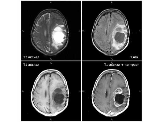 МРТ от 26.02.19: стремительное нарастание отрицательной динамики