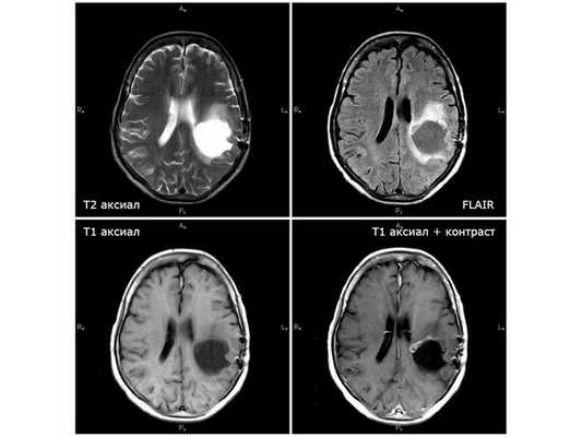 МРТ от 21.11.18 (через 7 недель после первого этапа химиолучевой терапии): единственный случай положительной динамики