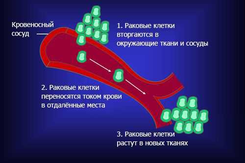 Образование метастазов
